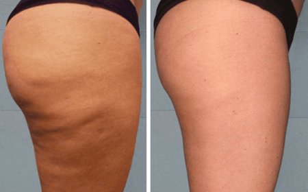 Виды антицеллюлитного массажа