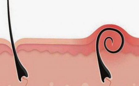 Как избавиться от вросших волосков