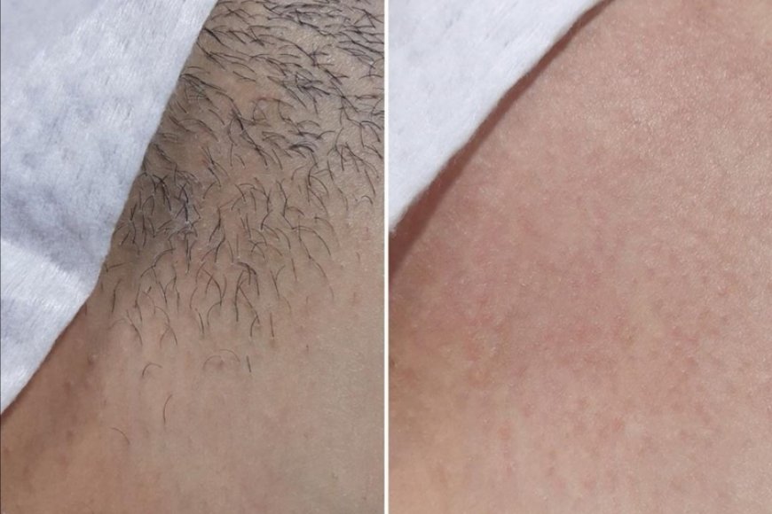 Лазерная эпиляция бикини и глубокое бикини. Ваксинг зоны глубокого бикини. Фолликулит и псевдофолликулит. Как брить интимную зону девушке бритвой правильно. Шугаринг бандажная техника глубокое бикини.