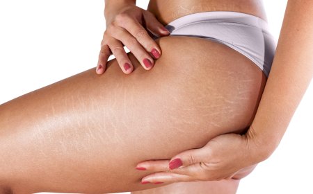 Как бороться с растяжками?