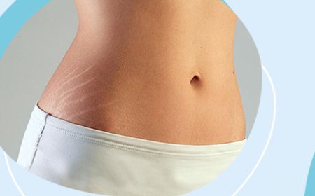 Как правильно избавиться от растяжек