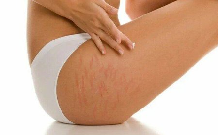 Растяжки на ногах. Как от них избавиться