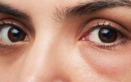 Как избавиться от отечности под глазами?