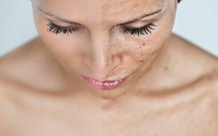 Пигментация у женщин