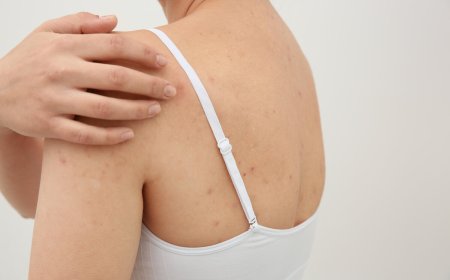 Как бороться с прыщами на спине