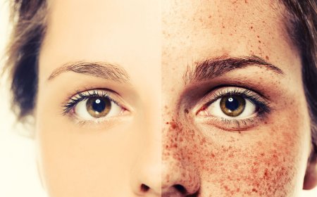 Летняя пигментация кожи: эффективно и безболезненно удаляем «солнечные поцелуи»