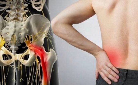 Защемление седалищного нерва: причины, признаки и методы лечения