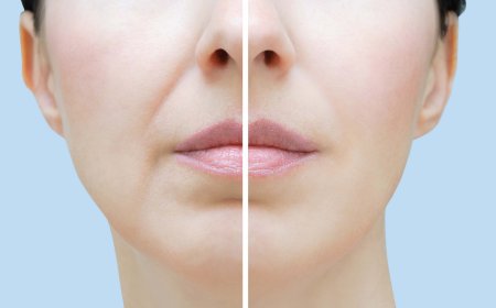 Как избавиться от носогубных складок? 7 способов