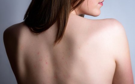 Прыщи на спине и в области декольте: как справиться и какую косметику выбрать?