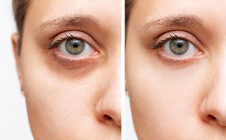 Боремся с темными кругами под глазами