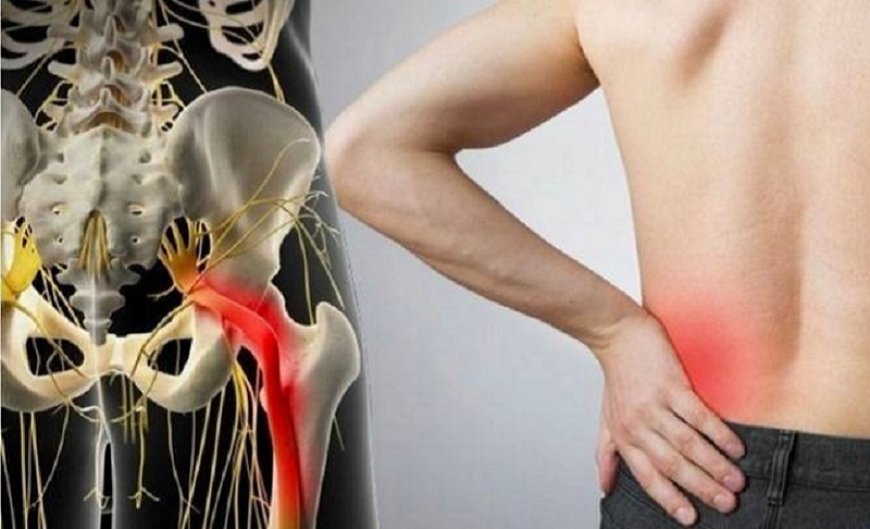 Защемление седалищного нерва: причины, признаки и методы лечения