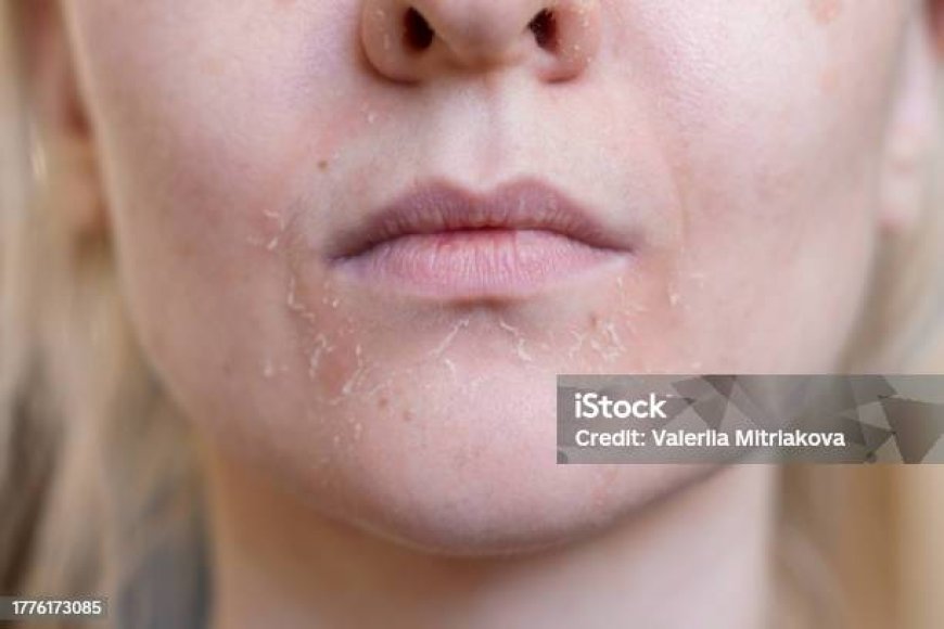 Почему кожа зимой становится сухой и как с этим бороться